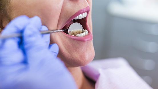 Close up of a dentist examining a patient's mouth with a dental mirror