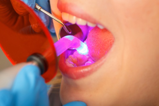 Dentist working with dental polymerization lamp in oral cavity at Uptown Family Dental in Portland, OR