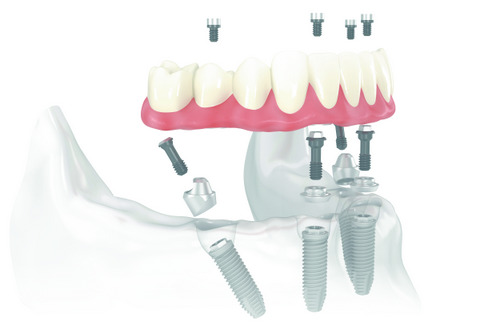 Diagram of All-On-4 Treatment Concept at Uptown Family Dental in Portland, OR