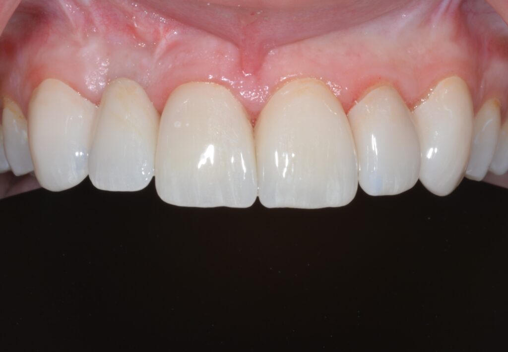 a photo of a patient's teeth after dental veneersbest dentist for veneers