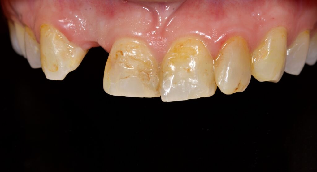 Upper front teeth of a patient that wanted dental veneersBest dentist for veneers