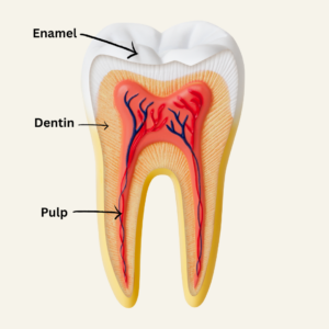 A diagram of a tooth showing the enamel, dentin, and pulp. You may need a root canal if your cavity has reached the pulp in this diagram.