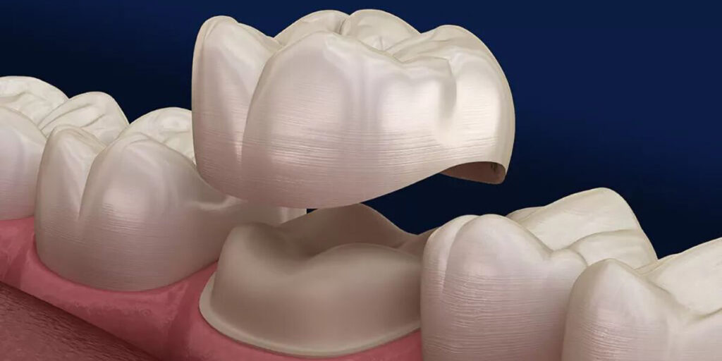 Dental crowns depicted being placed on a natural tooth.