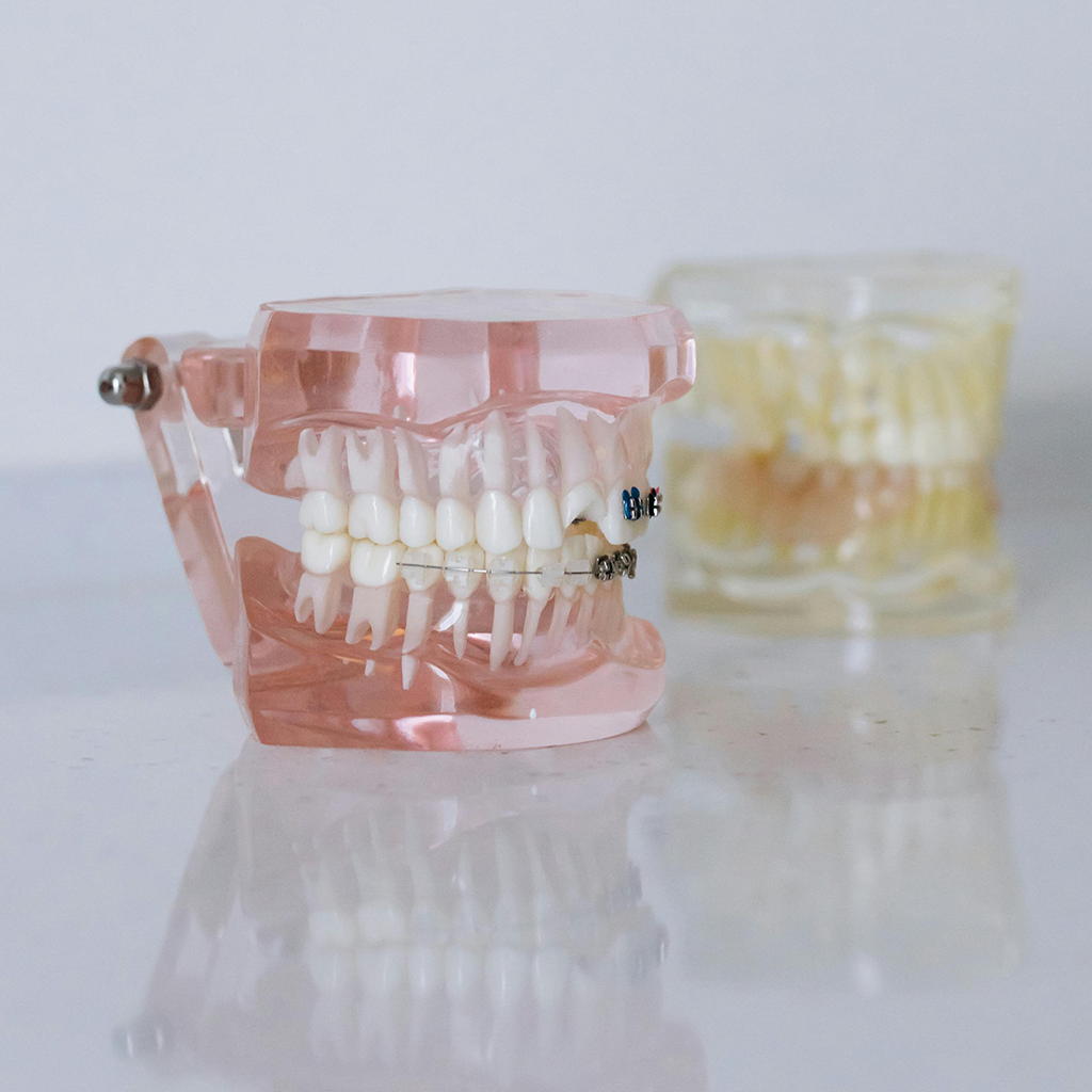Sleep-Apnea-and-Dental-Based-Treatment-Options